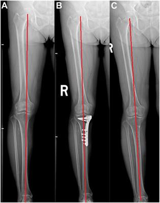 Medial opening-wedge high tibial osteotomy with microfracture in treatment of varus medial compartmental knee osteoarthritis: clinical outcomes and second-look arthroscopic results